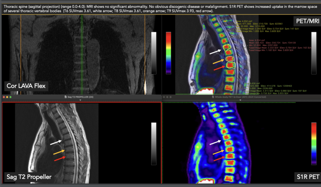 This image has an empty alt attribute; its file name is Vertebral-Osteitis-1024x596.png